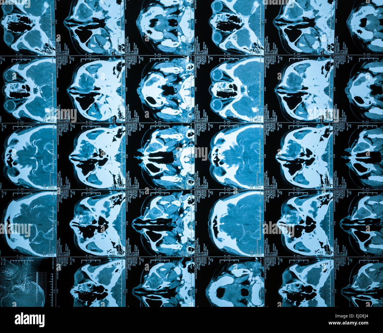 Brain CT, flash remake of the film Stock Photo