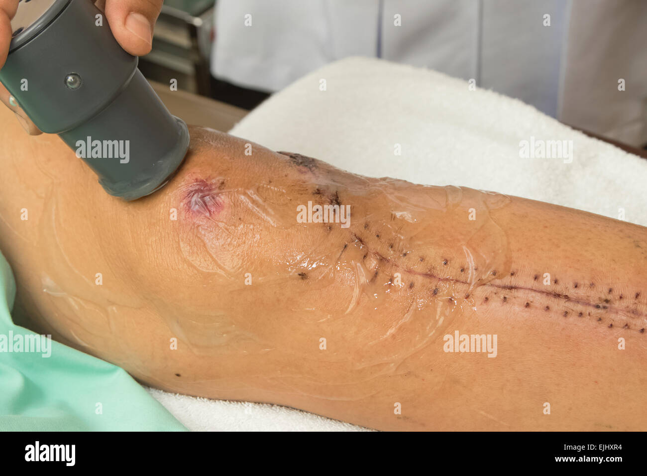 Physiotherapist treats knee surgery wound Stock Photo