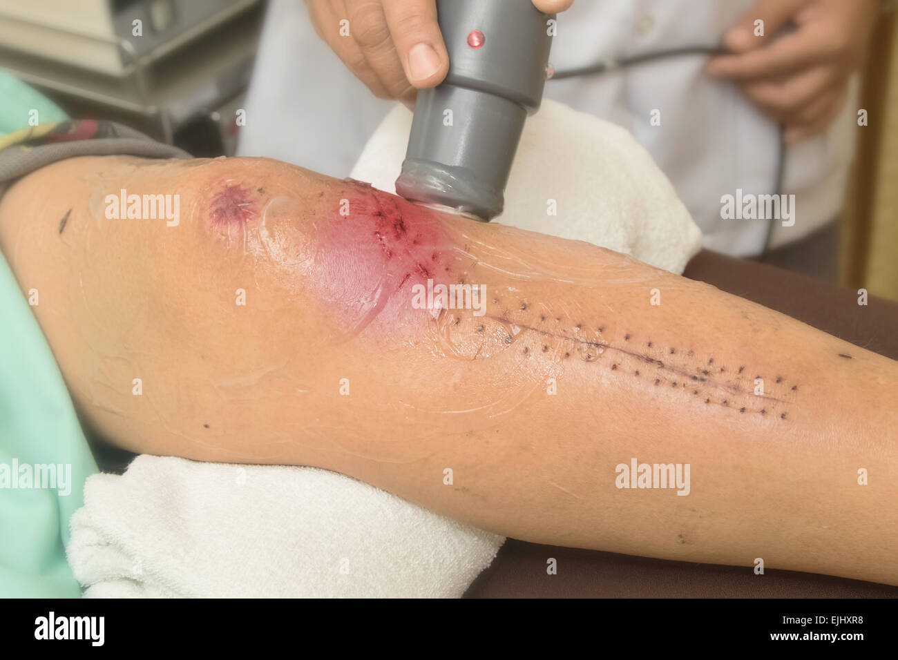 Physiotherapist treats knee surgery wound Stock Photo