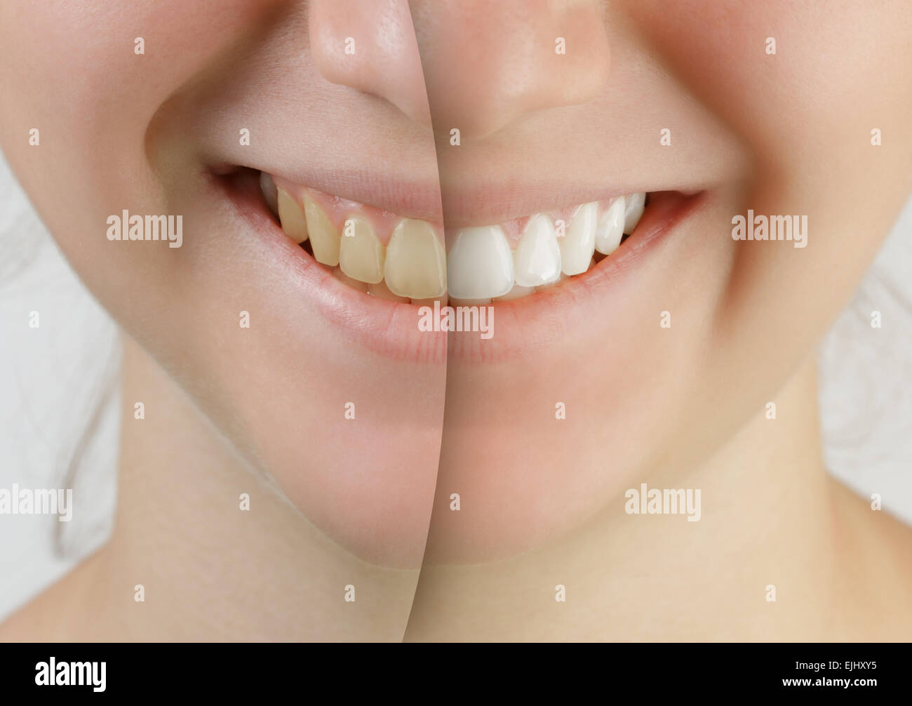 teen girl smile before and after teeth whitening Stock Photo