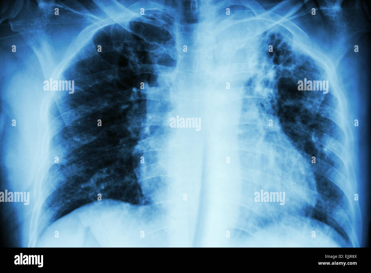 Pulmonary Tuberculosis .  Chest X-ray : interstitial infiltration at left upper lung due to Mycobacterium Tuberculosis infection Stock Photo