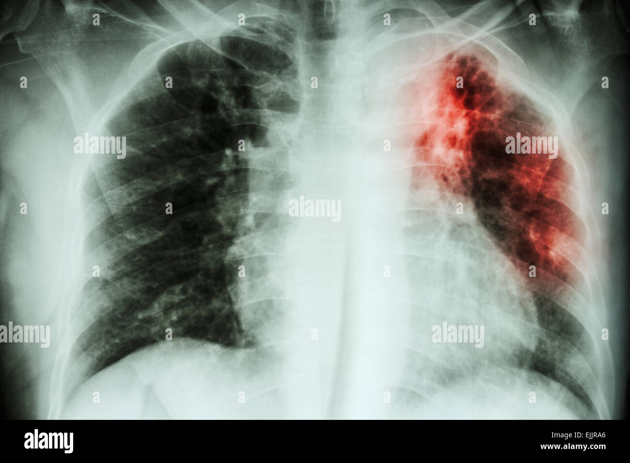 Upper Respiratory Tract Infection Wikipedia bacterial-infection-names