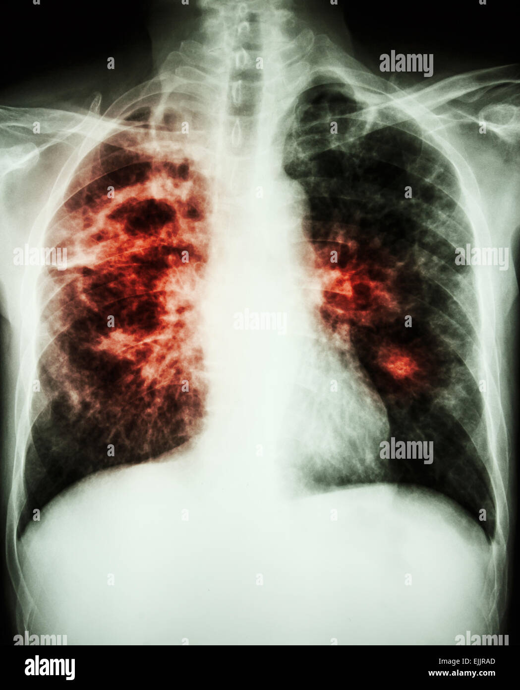 film chest xray show cavity at right lung,fibrosis & interstitial