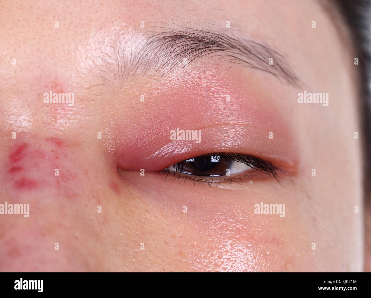 Swollen eyelid hires stock photography and images Alamy