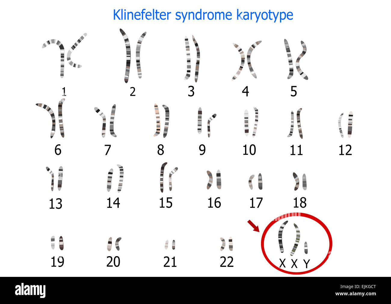 Klinefelter syndrome karyotype Stock Photo