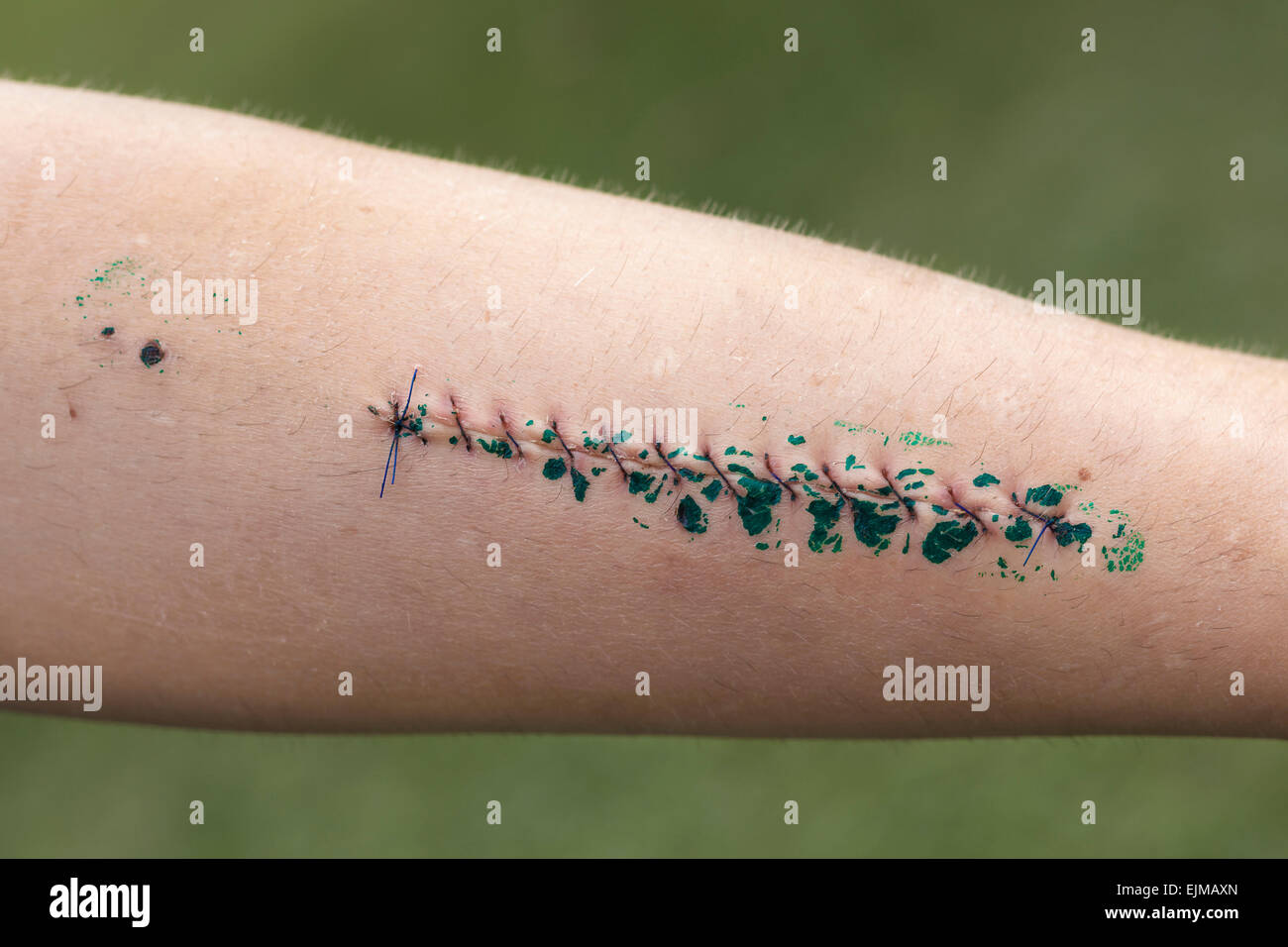 Closeup of wound and stitches on male forearm. Stock Photo