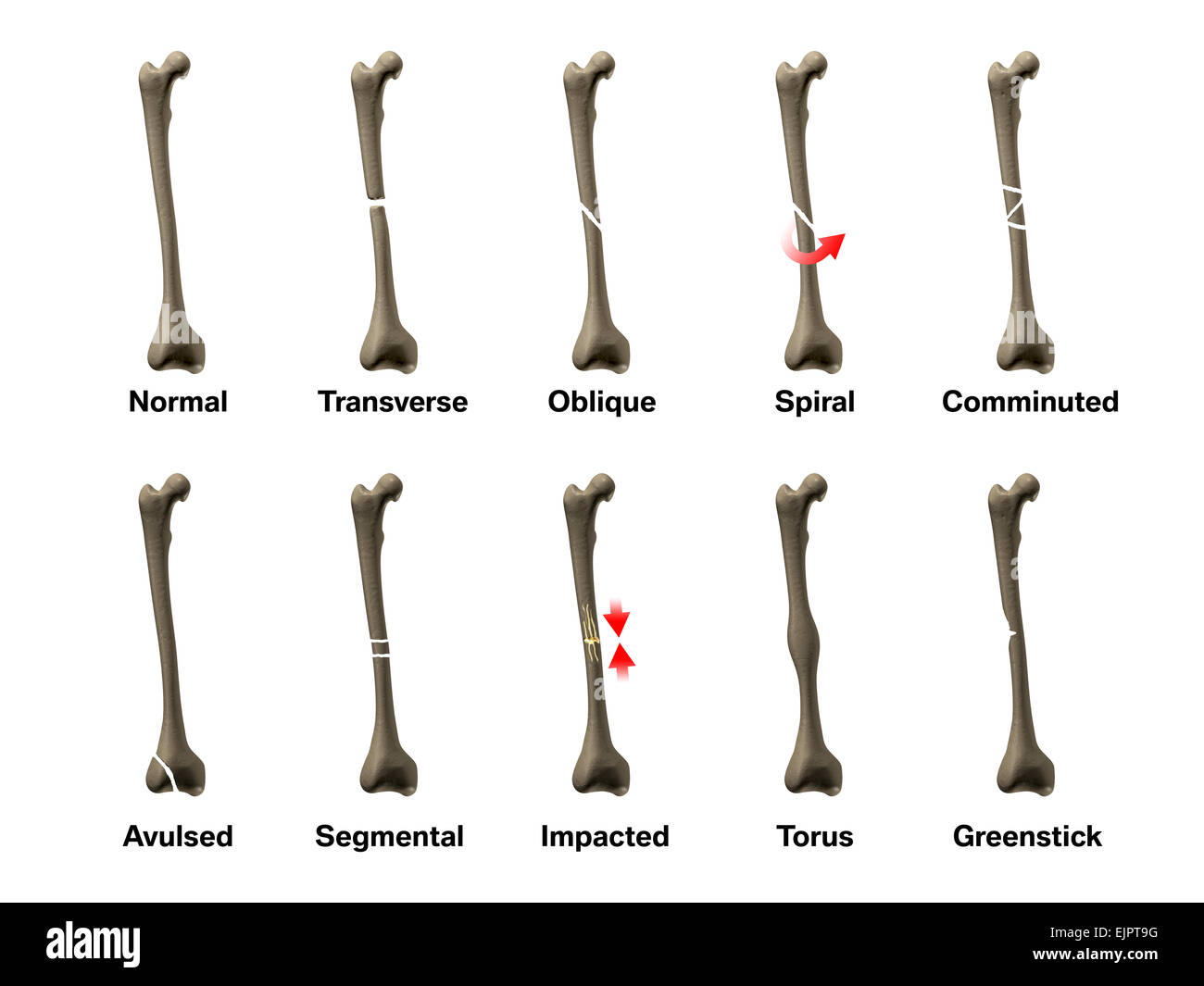 Перелом кости все виды