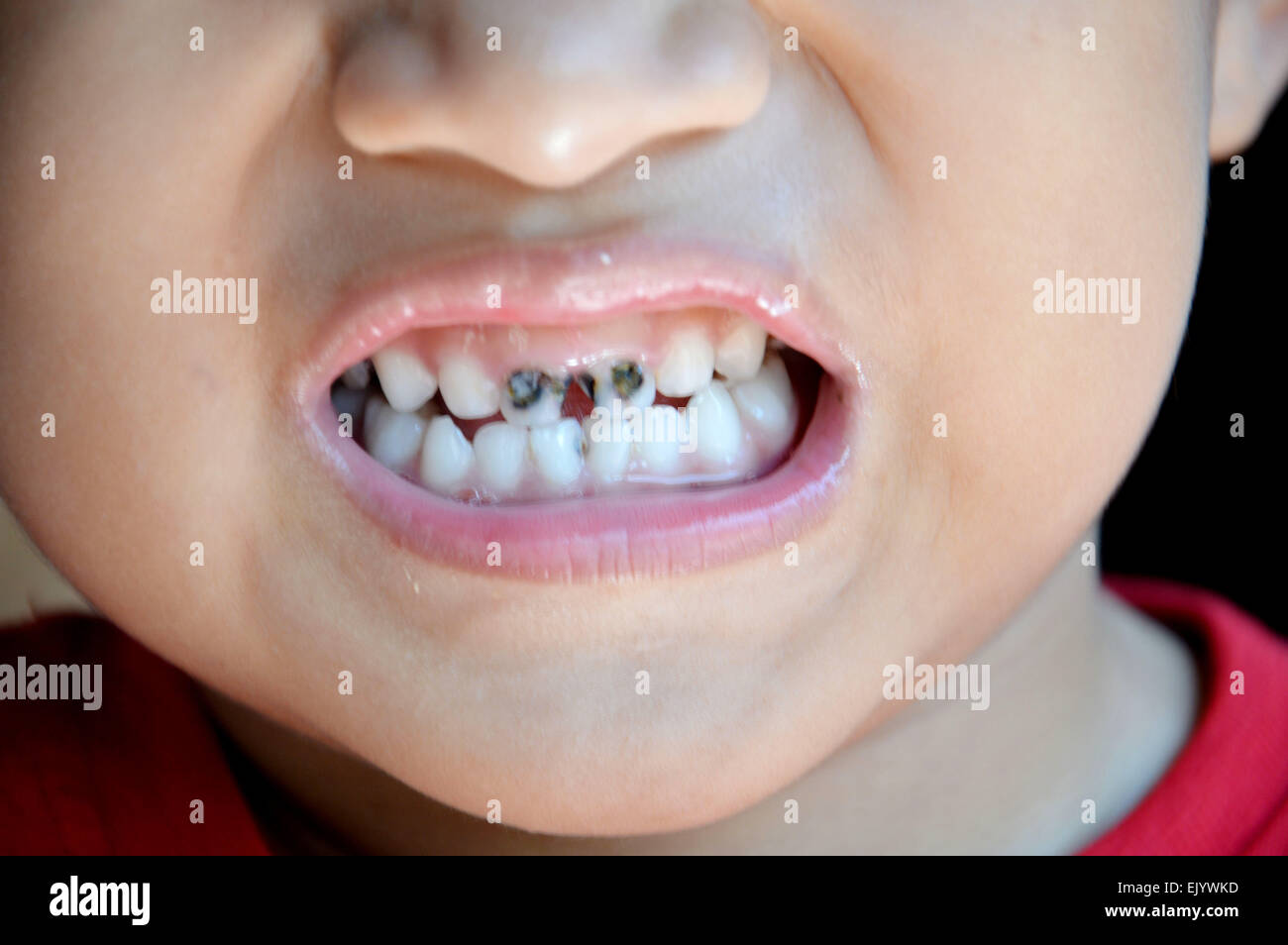 children's dental cavities Stock Photo Alamy