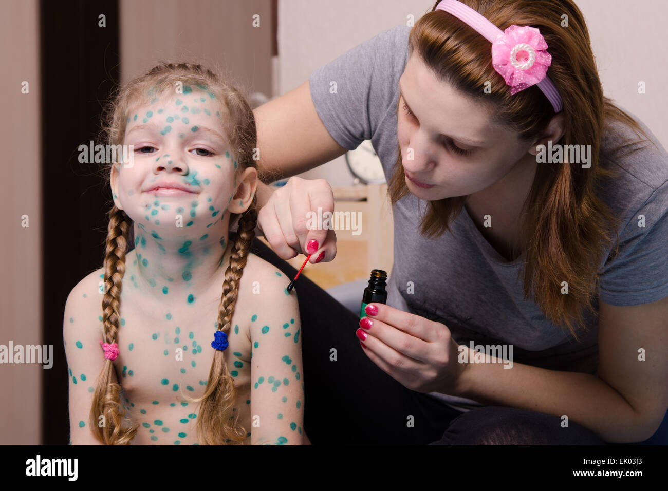 Mom misses zelenkoj sores on the body of a child suffering from chickenpox Stock Photo