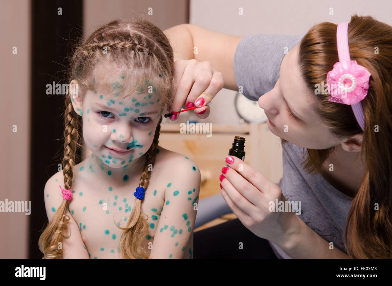 Mom misses zelenkoj sores on the face of a child suffering from chickenpox Stock Photo