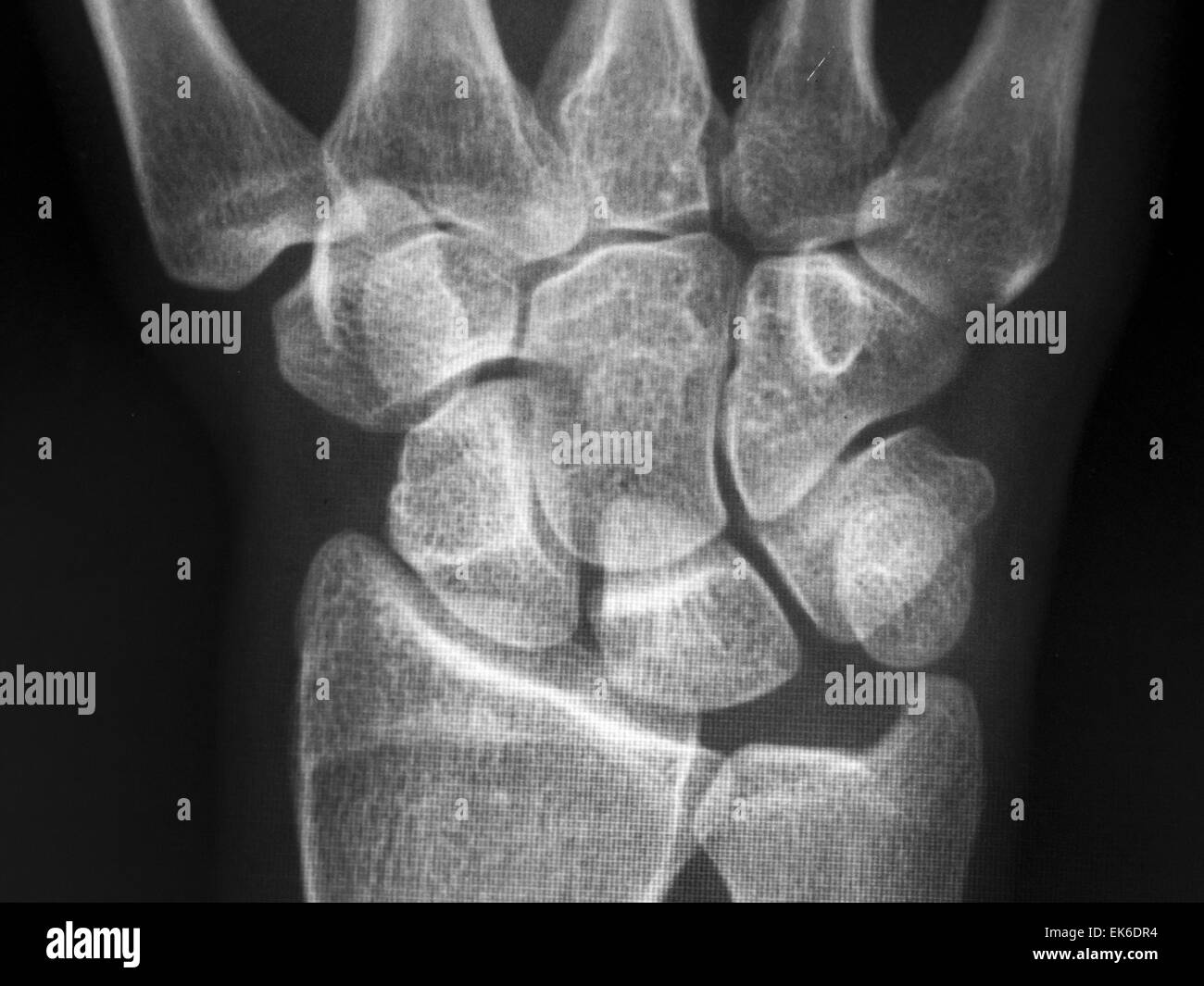 X-Ray Of Carpal And Metacarpal Bones In The Human Hand Stock Photo