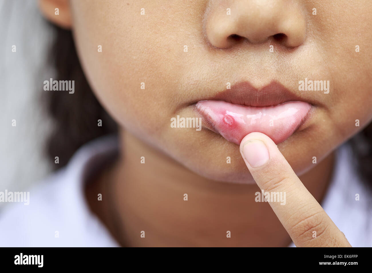 Close up Children with aphtha on lip Stock Photo