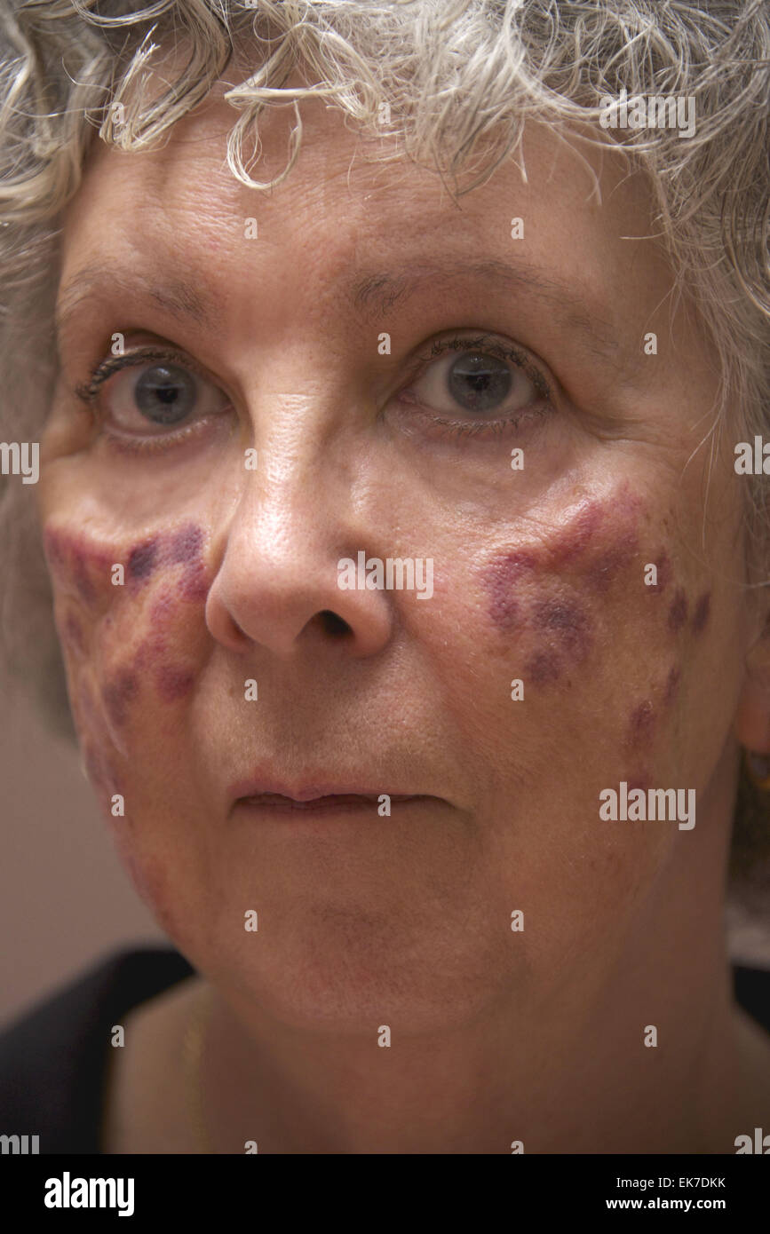 Laser burn skin hi-res stock photography and images - Alamy