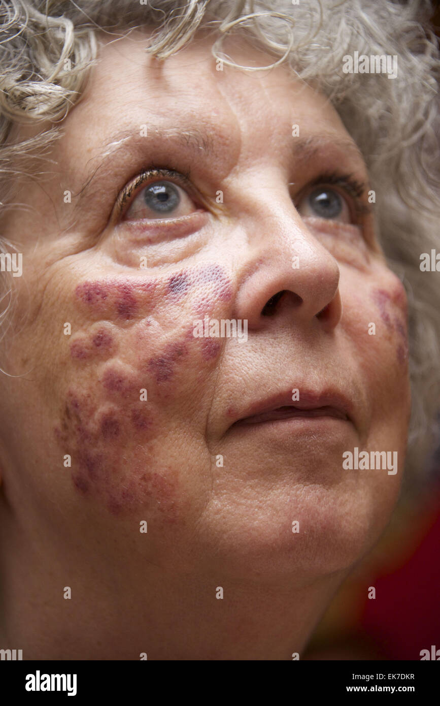 Laser burn skin hi-res stock photography and images - Alamy