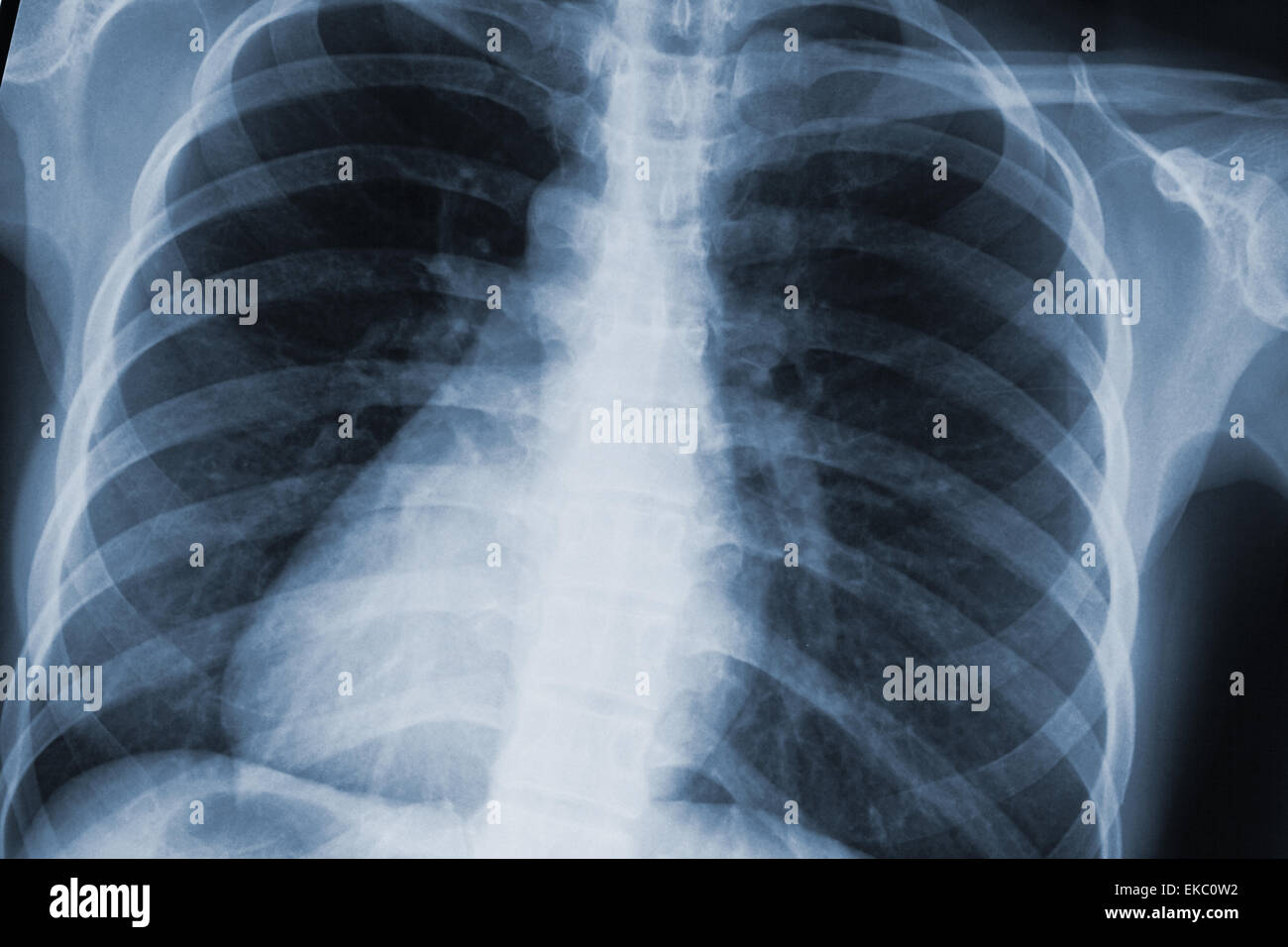 chest xray scan Stock Photo