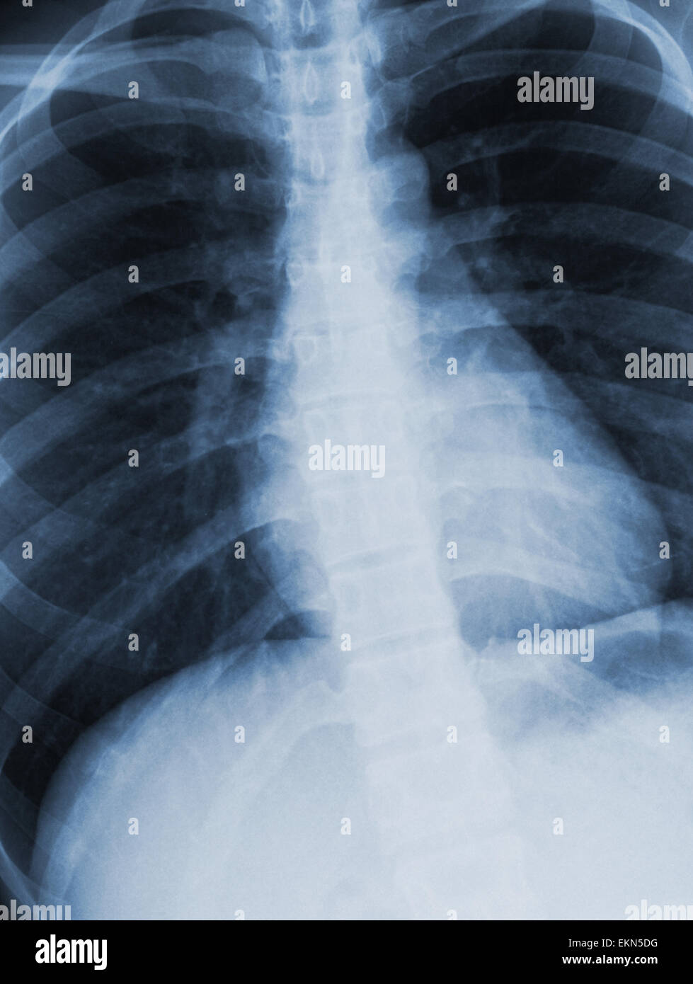Broken ribs xray hires stock photography and images Alamy
