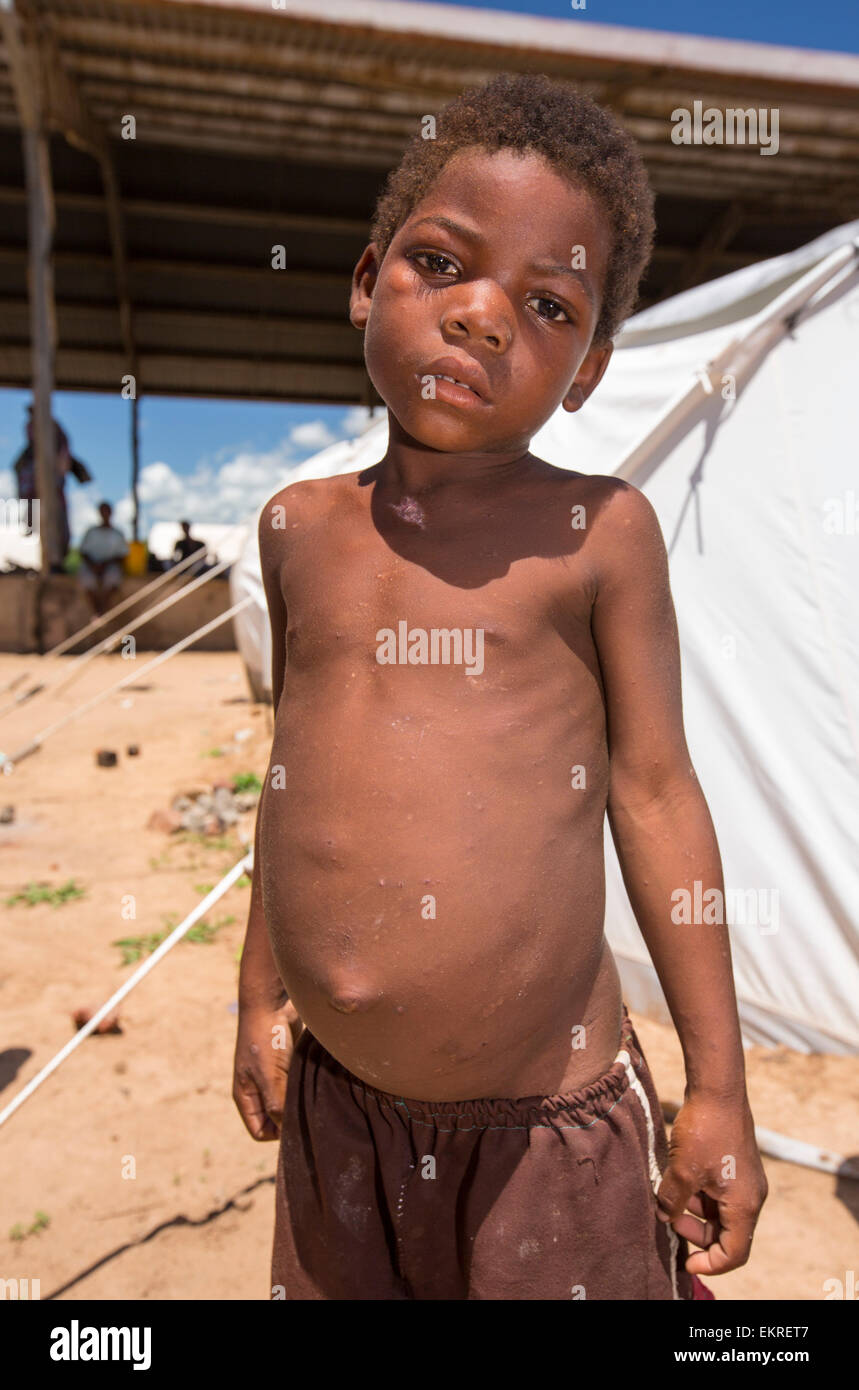 In mid January 2015, a three day period of excessive rain brought unprecedented floods to the small poor African country of Malawi. It displaced nearly quarter of a million people, devastated 64,000 hectares of land, and killed several hundred people. This shot shows a malnourished child in a refugee camp in Bangula. Malawi is one of the poorest countries in the world with high levels of child hunger, that si being hugely exascerbated by climate change. Stock Photo