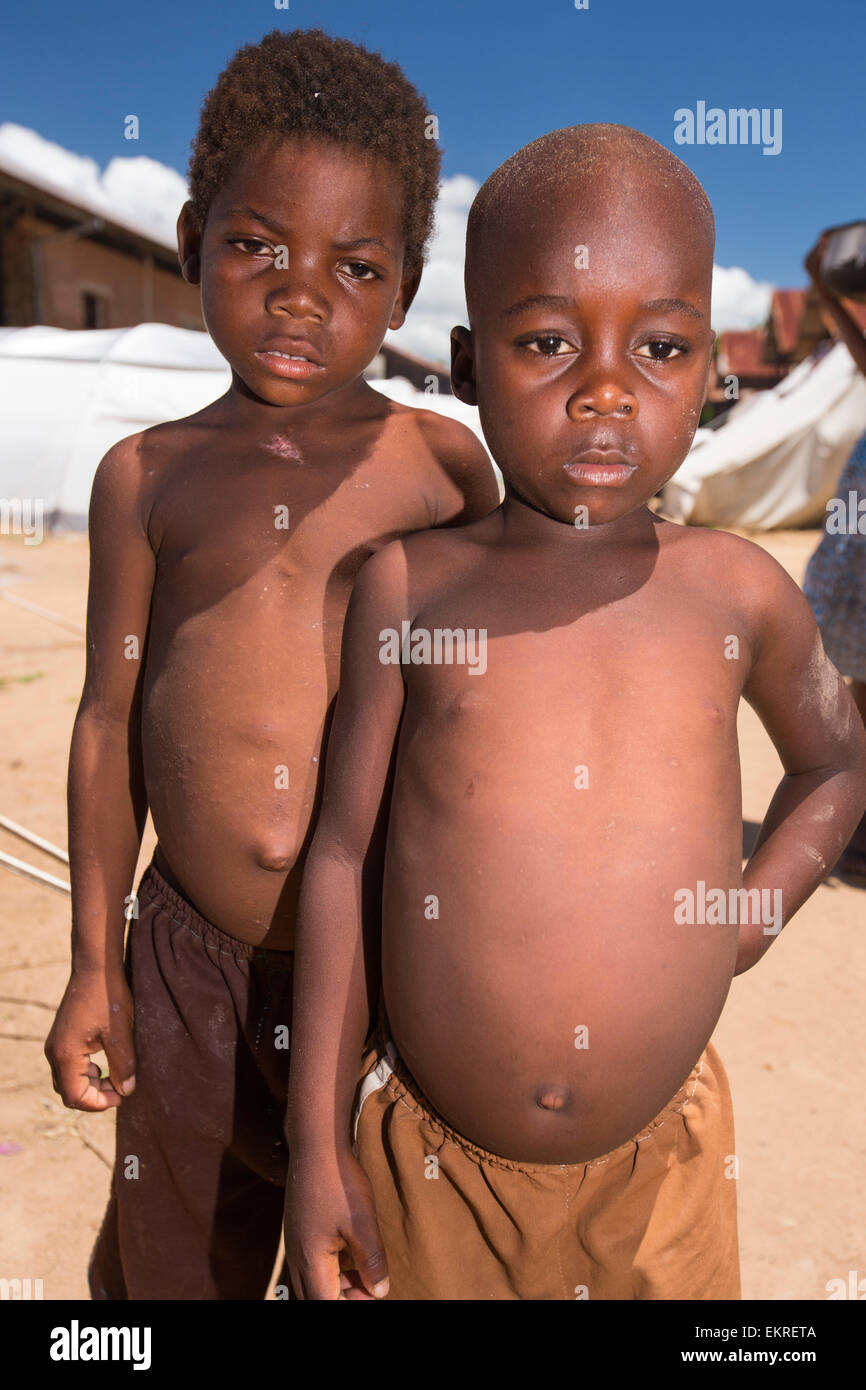 In mid January 2015, a three day period of excessive rain brought unprecedented floods to the small poor African country of Malawi. It displaced nearly quarter of a million people, devastated 64,000 hectares of land, and killed several hundred people. This shot shows a malnourished child in a refugee camp in Bangula. Malawi is one of the poorest countries in the world with high levels of child hunger, that si being hugely exascerbated by climate change. Stock Photo