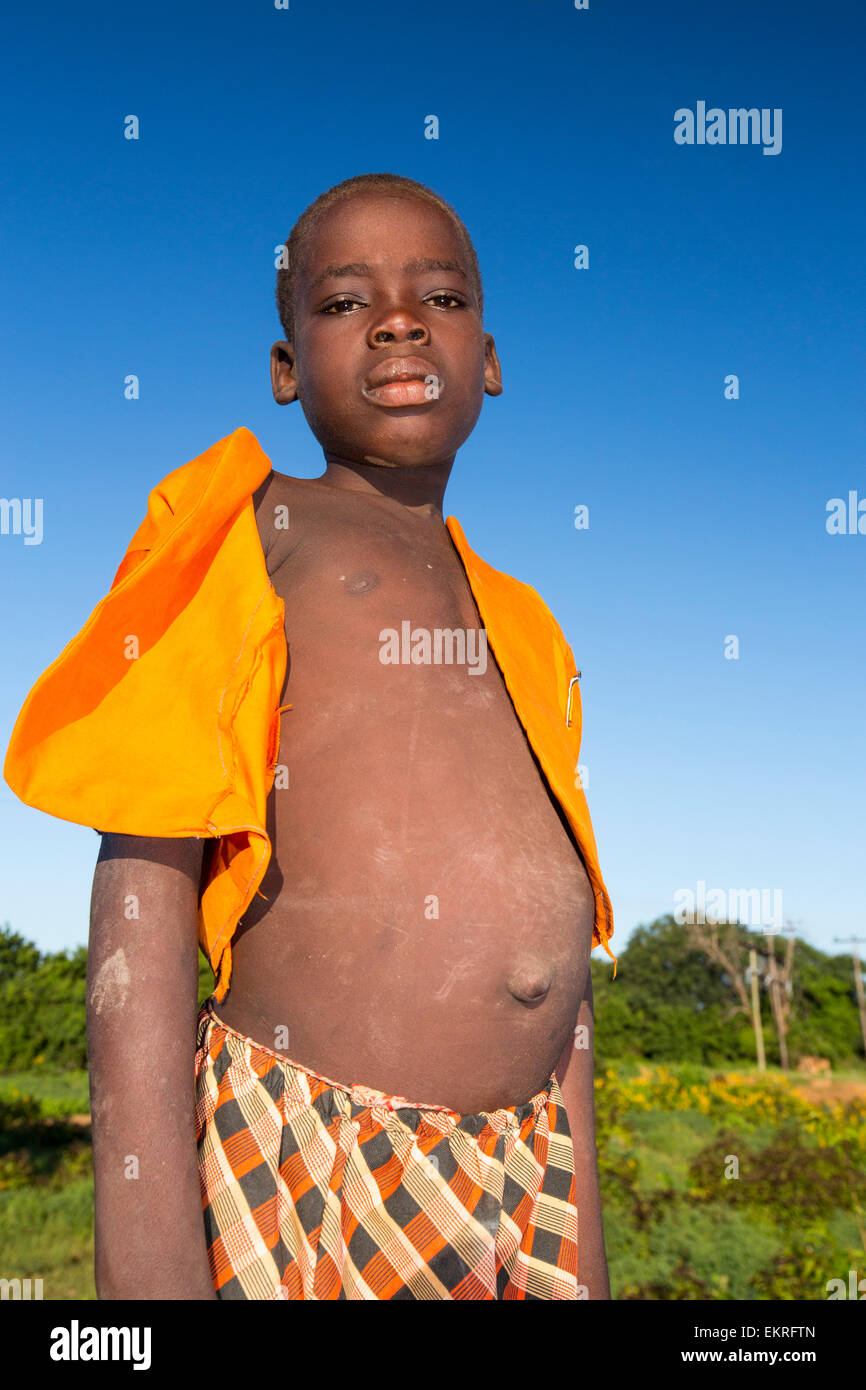 A malnourished boy in Malawi. Levels of child hunger are rising in Malawi as a result of climate change, which is negatively impacting agricultural production. Stock Photo