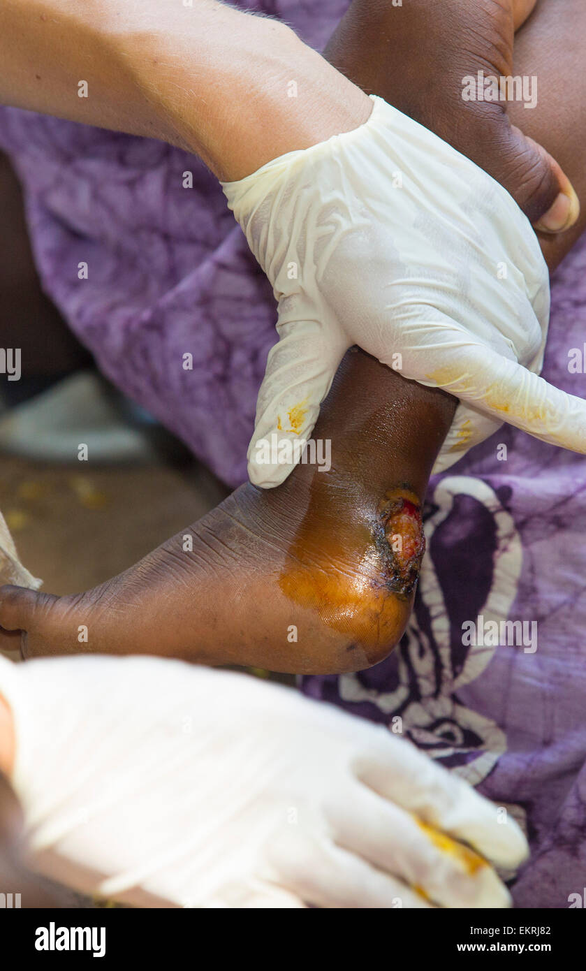 In mid January 2015, a three day period of excessive rain brought unprecedented floods to the small poor African country of Malawi. It displaced nearly quarter of a million people, devastated 64,000 hectares of land, and killed several hundred people. This shot shows A Medicin Sans Frontieres clinic in Makhanga to treat local people, many of whom now have malaria, as a result of the drying up flood waters providing ideal breeding grounds for mosquitoes. Stock Photo