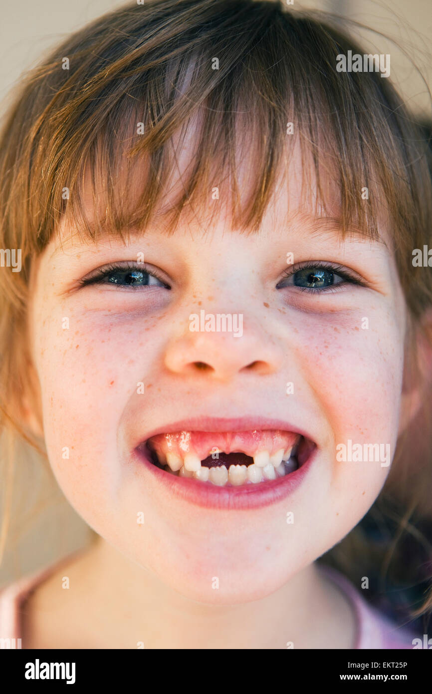 Young Girl With Missing Front Teeth; Gold Coast Queensland Australia Stock Photo