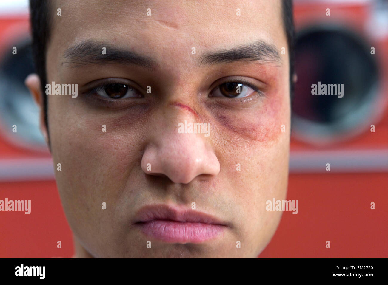Portrait of a young man with black eye Stock Photo - Alamy