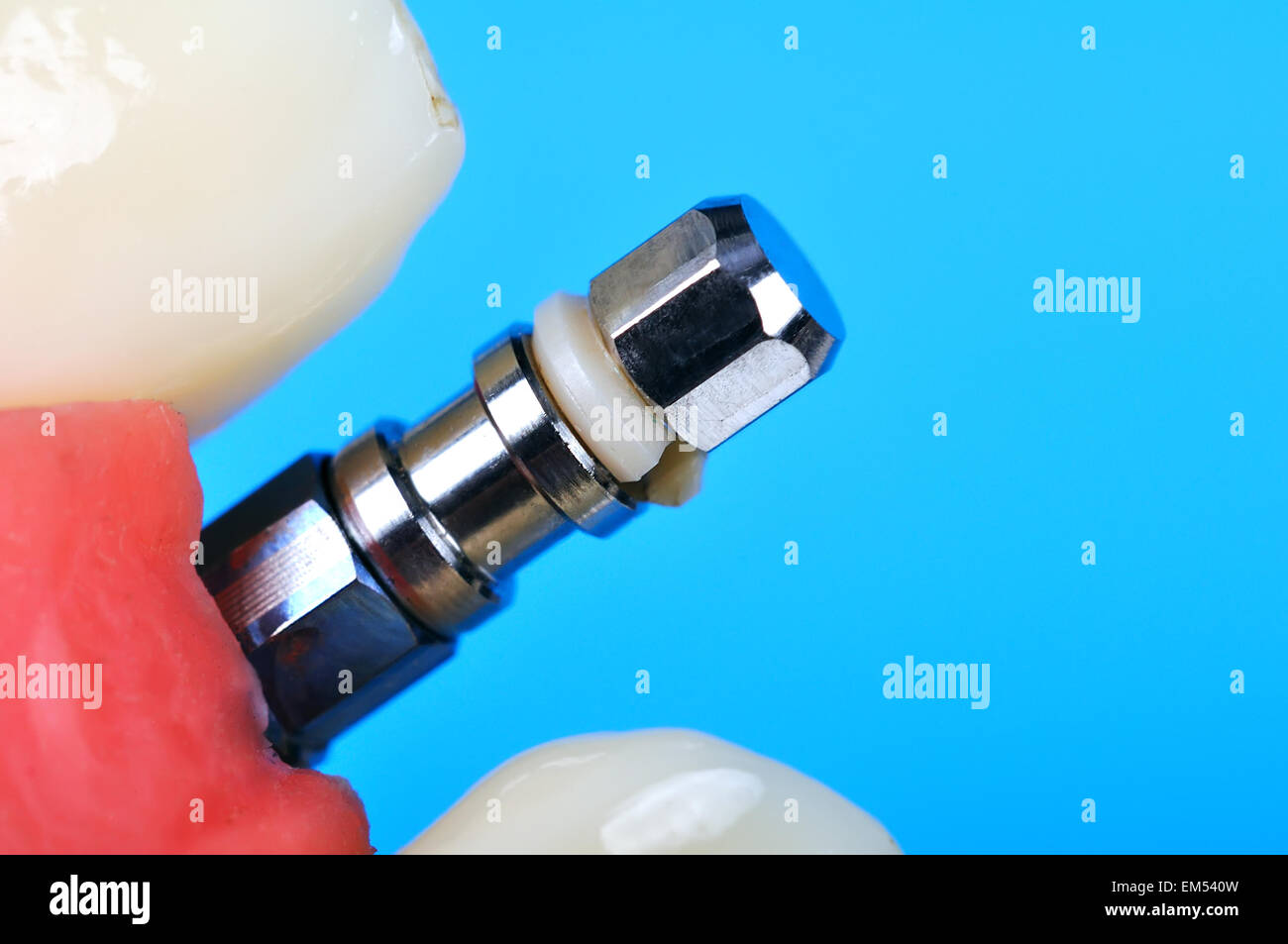 Dental implant implanted in jaw bone, close up Stock Photo Alamy