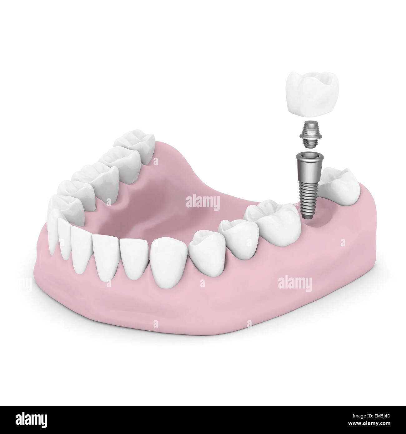 Dental implants Stock Photo