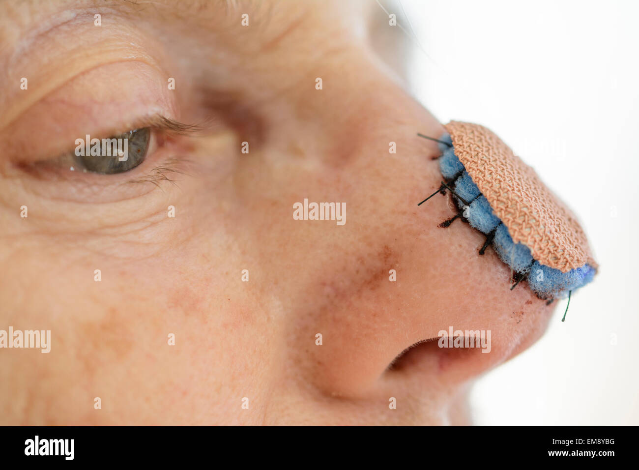 Dressing on a woman's nose after a skin graft. Stitches after nose surgery Stock Photo