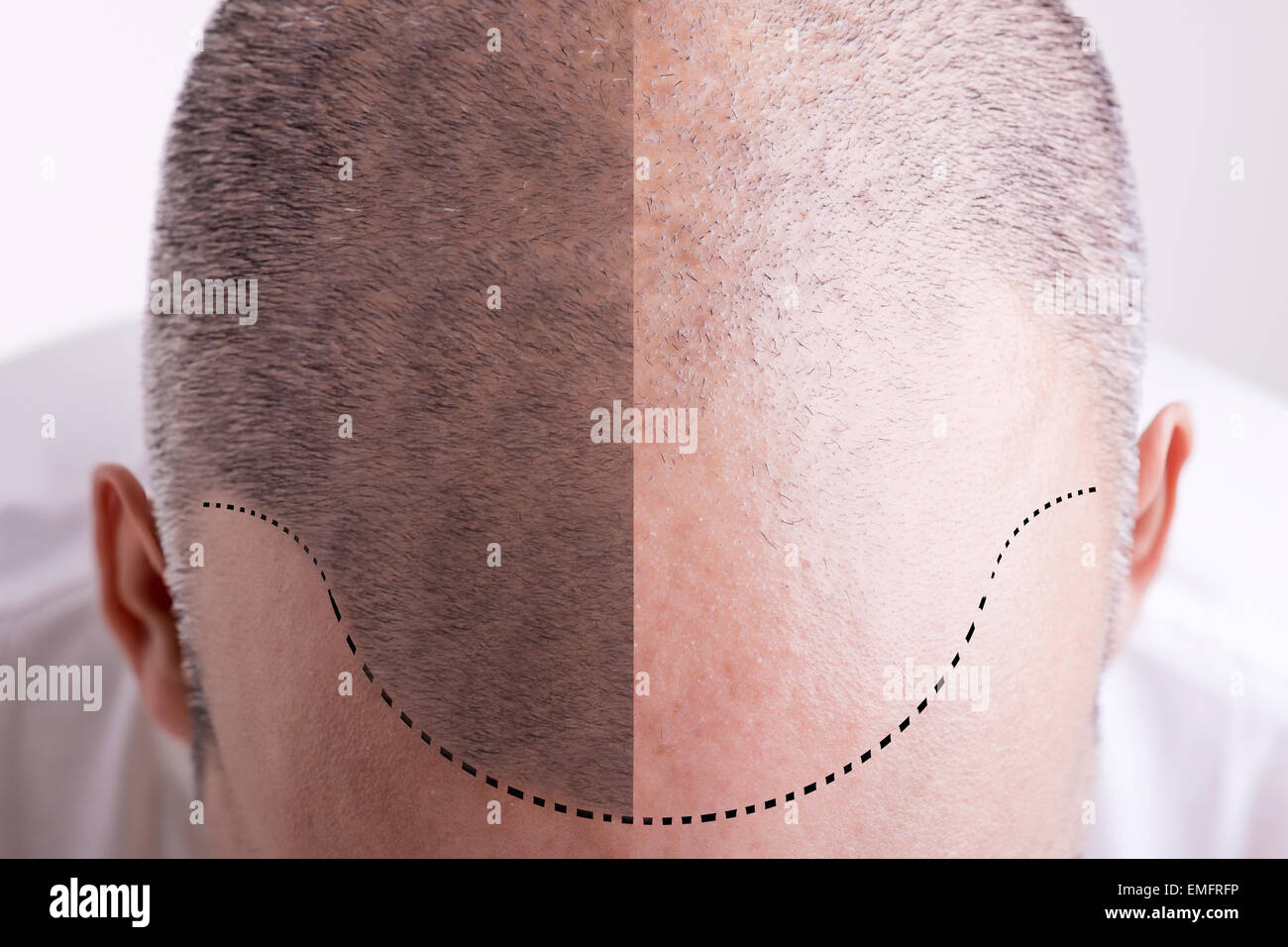 Top view of a men's head with a receding hair line - Before and After Stock Photo