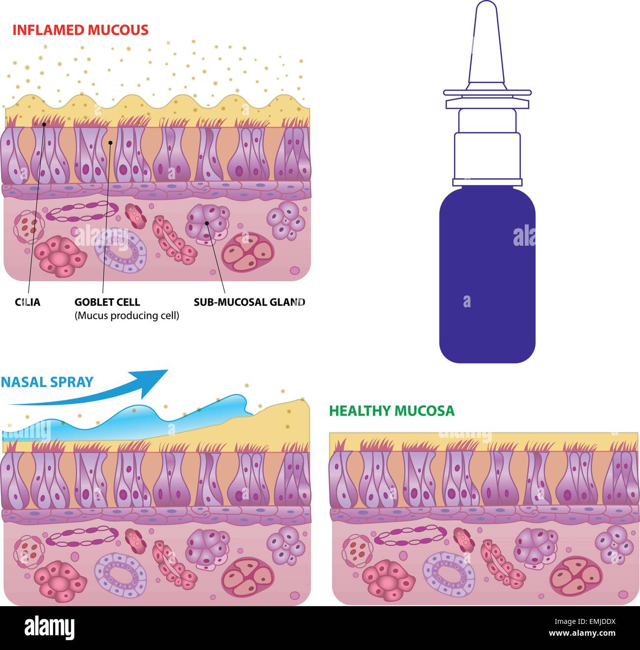 Inflamed and normal nasal mucosa cells and micro cilia vector scheme with nasal spray effect and bottle Stock Vector