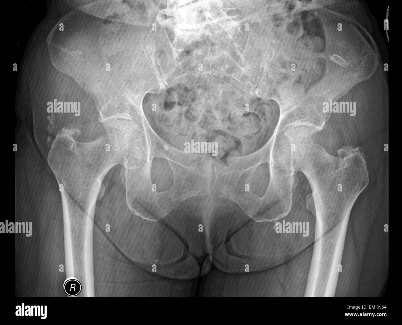 X-RAY radiology  image of old woman pelvis with osteoporosis Stock Photo