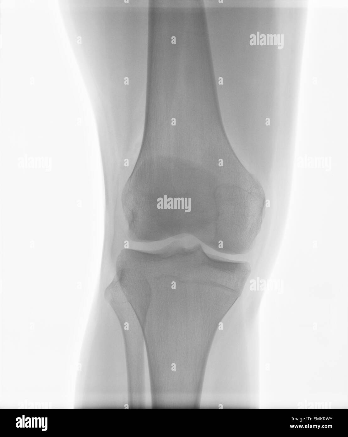Authentic xray of male right knee with injured caused by sport games