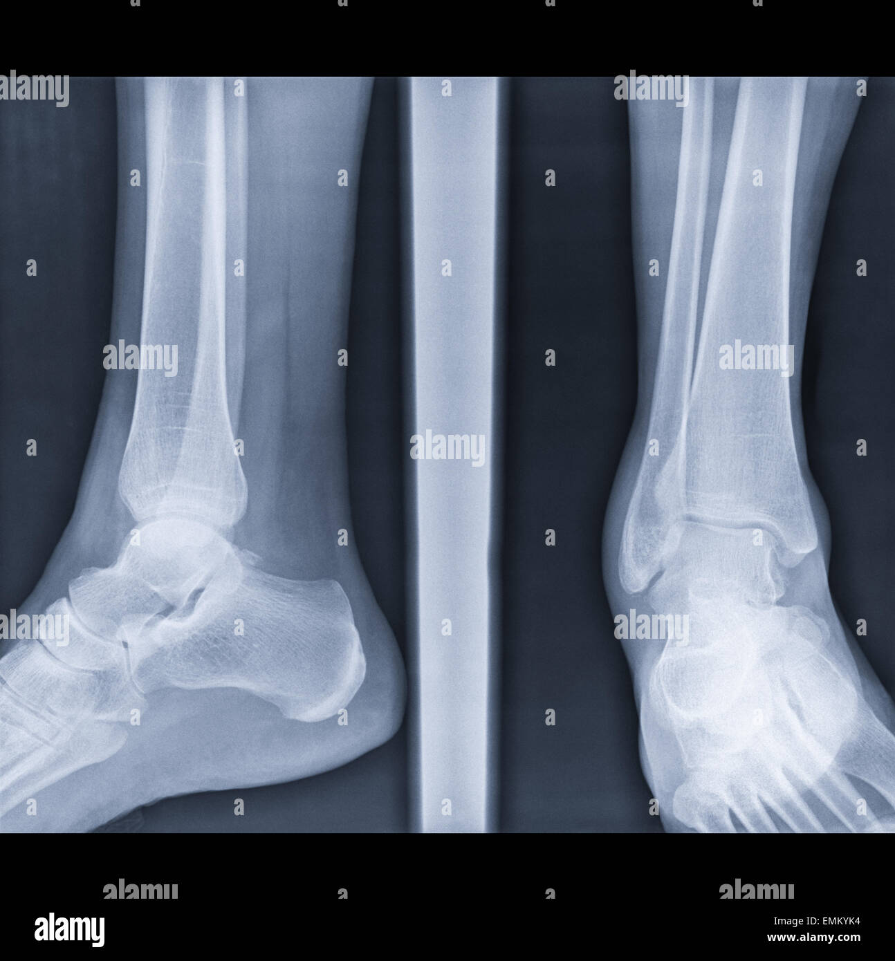earing of injured joint capsule of legs on authentic x-ray picture fracture fibula bone Stock Photo