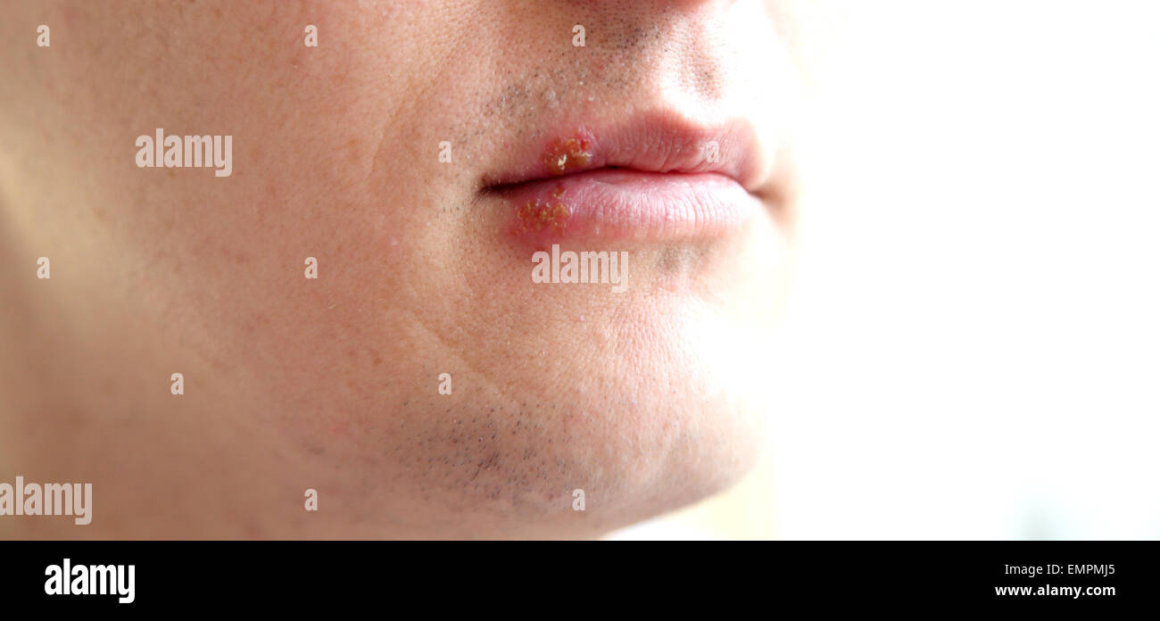 wound from herpes on the lips Stock Photo