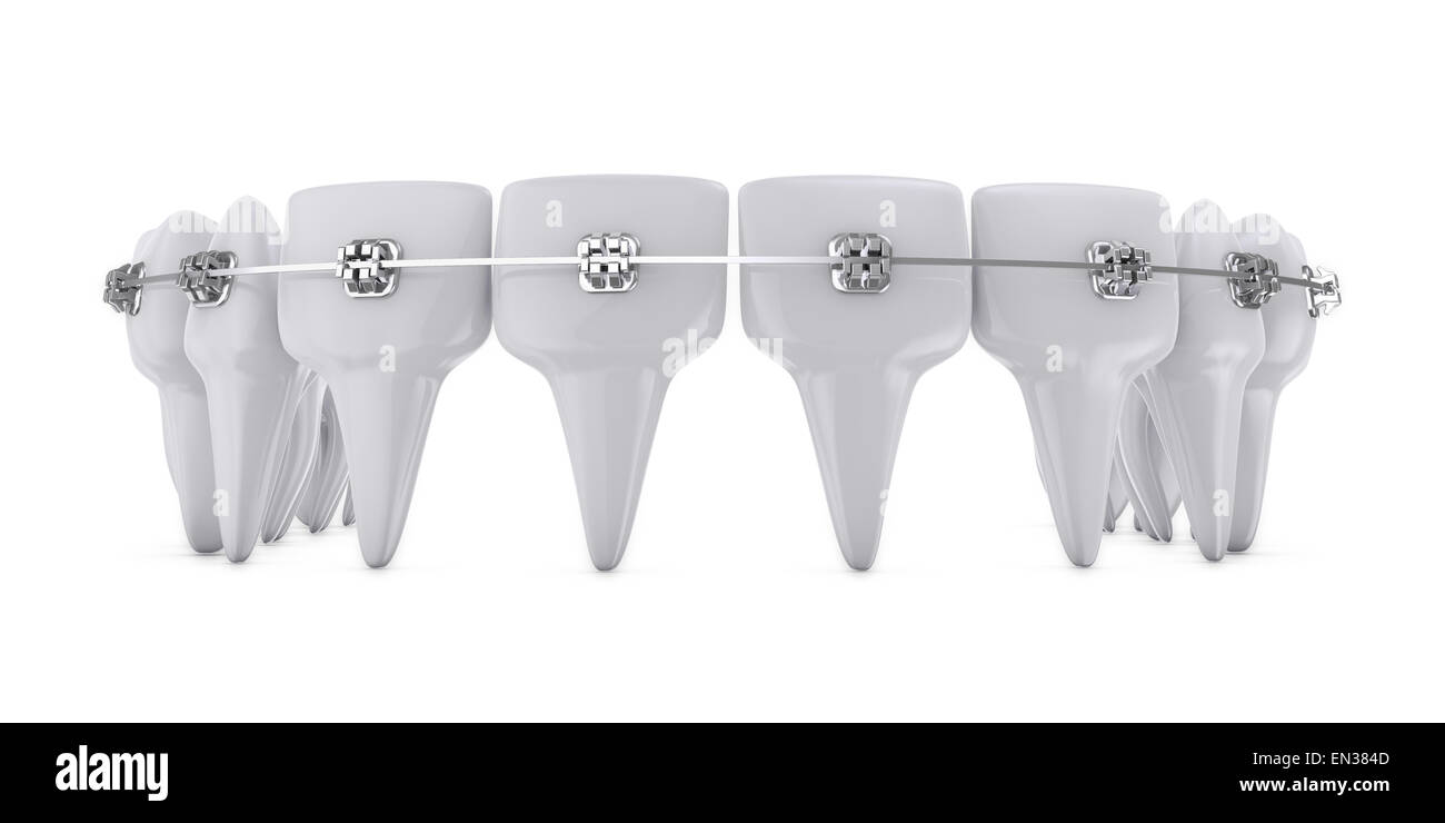 metal dental brackets mounted on the teeth Stock Photo Alamy