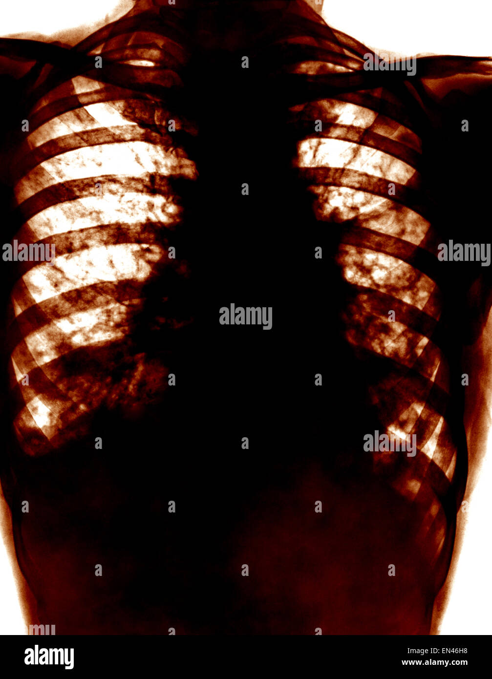 x-ray through human chest thoracic cavity showing shadow on the lung Bronchiectasis and widening of airways Stock Photo
