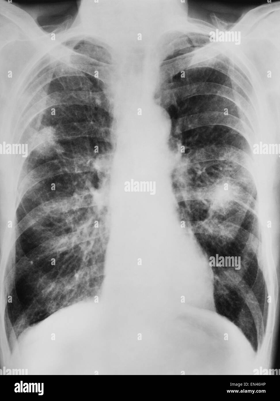 x-ray shadow on the lung engine smoker category b lung cancer of human thoracic chest Stock Photo