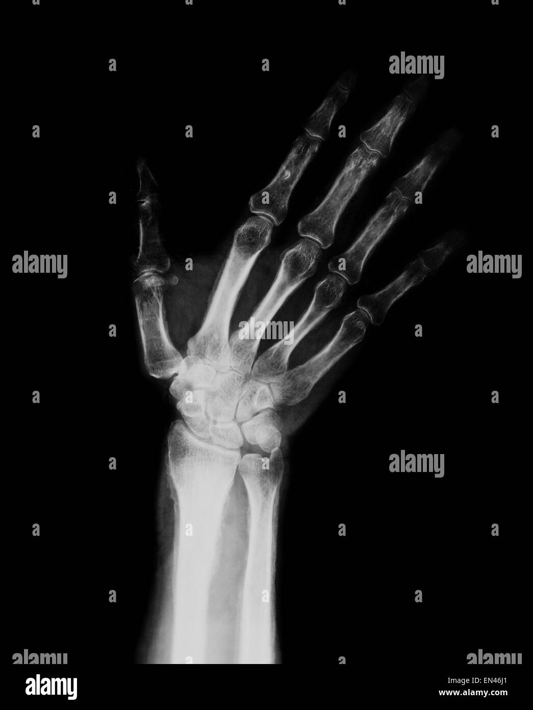 xray through adult hand and wrist with radius and ulna bones diagnostic treatment fingers thumb Stock Photo