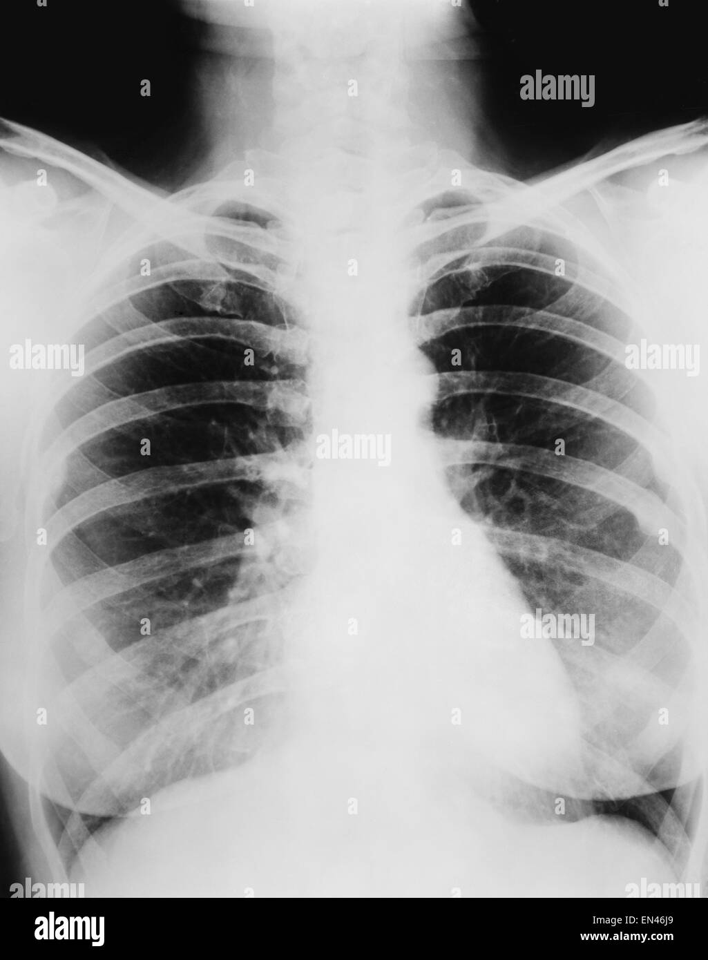 heavy wheezing cough fractures and small shadows on the lung in x-ray of human thoracic chest Stock Photo
