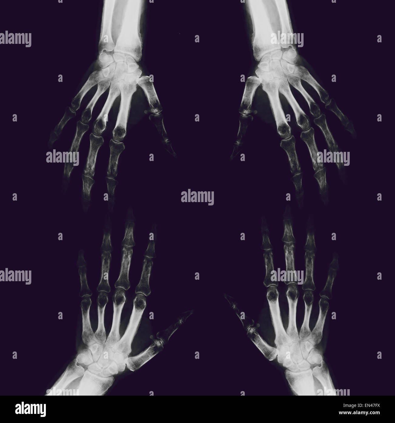 xray through adult hand and wrist with radius and ulna bones diagnostic