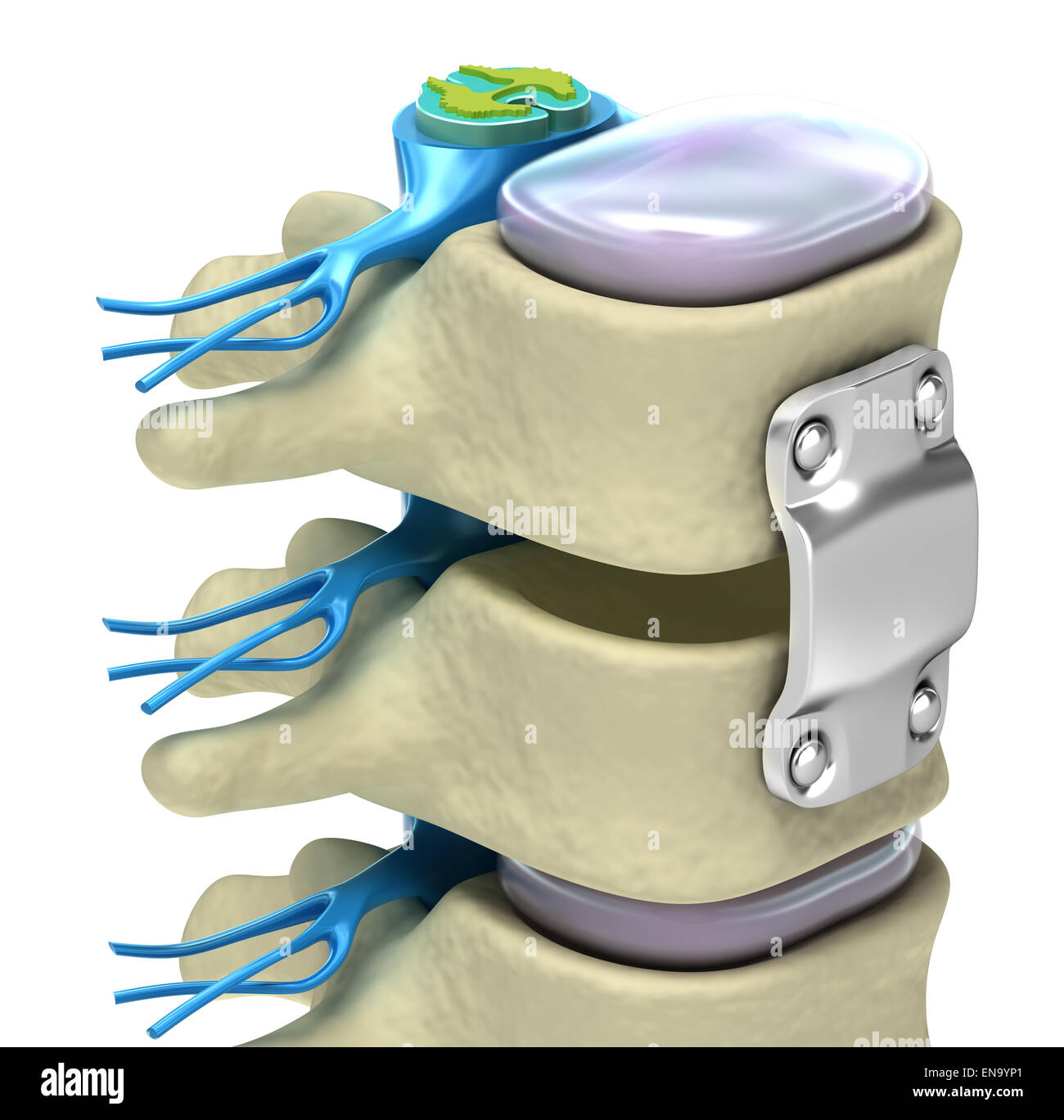 Spinal fixation system titanium bracket isolated on white Stock Photo