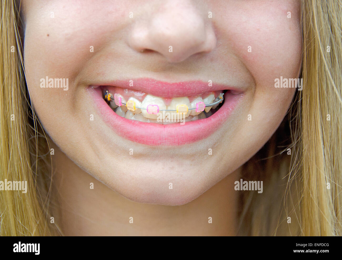 clear braces with purple bands