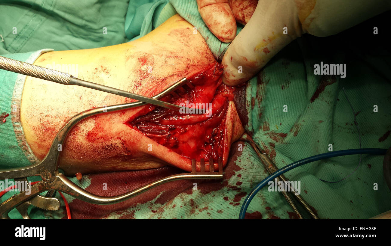 Ulnar nerve entrapment, decompression ulnar nerve at elbow Stock Photo