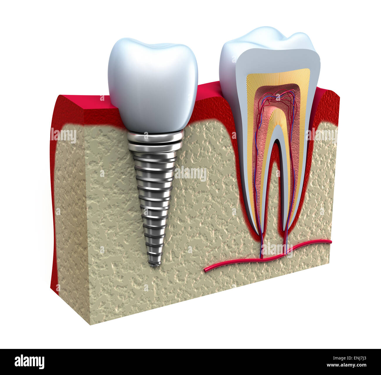 Anatomy of healthy teeth and dental implant in jaw bone Stock Photo Alamy