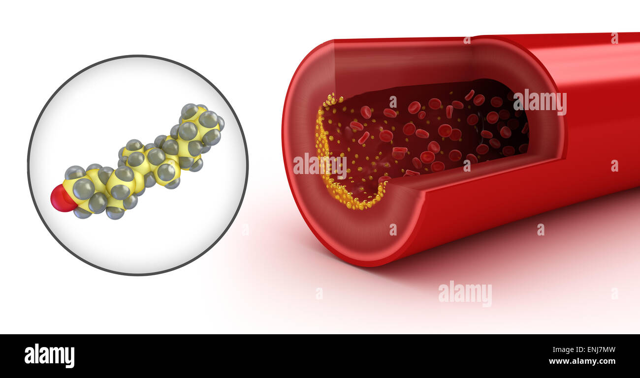 Cholesterol plaque in artery and cholesterol model Stock Photo Alamy