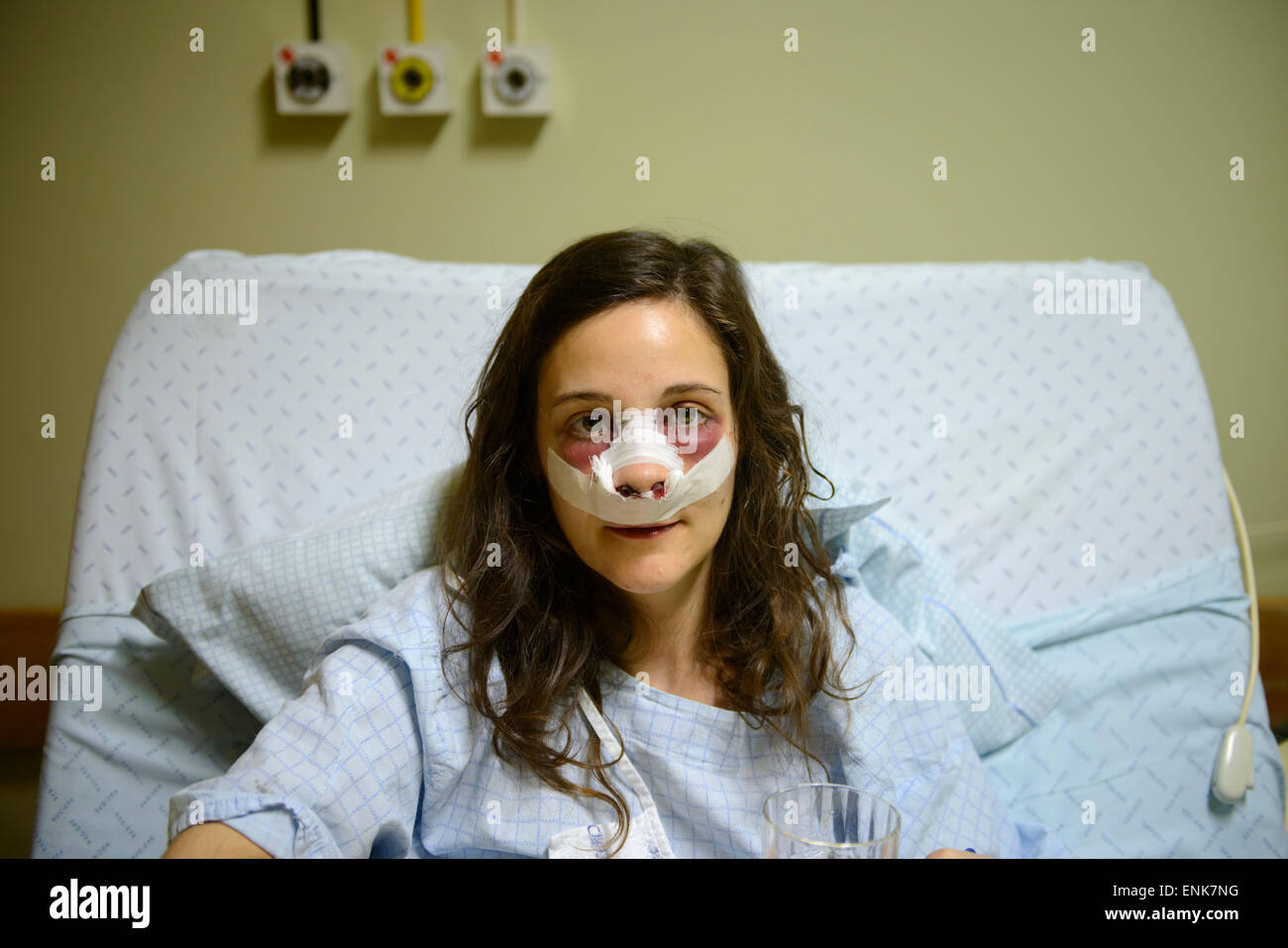 Young woman with bandages on face while recovering from a nose job