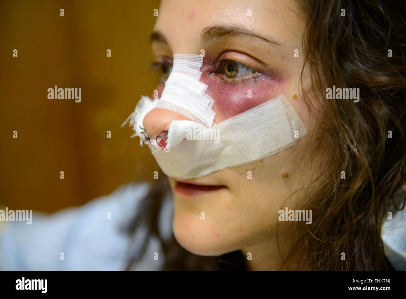 CIRURGIA NO NARIZ ! (OPERATE NOW) - nose surgery 