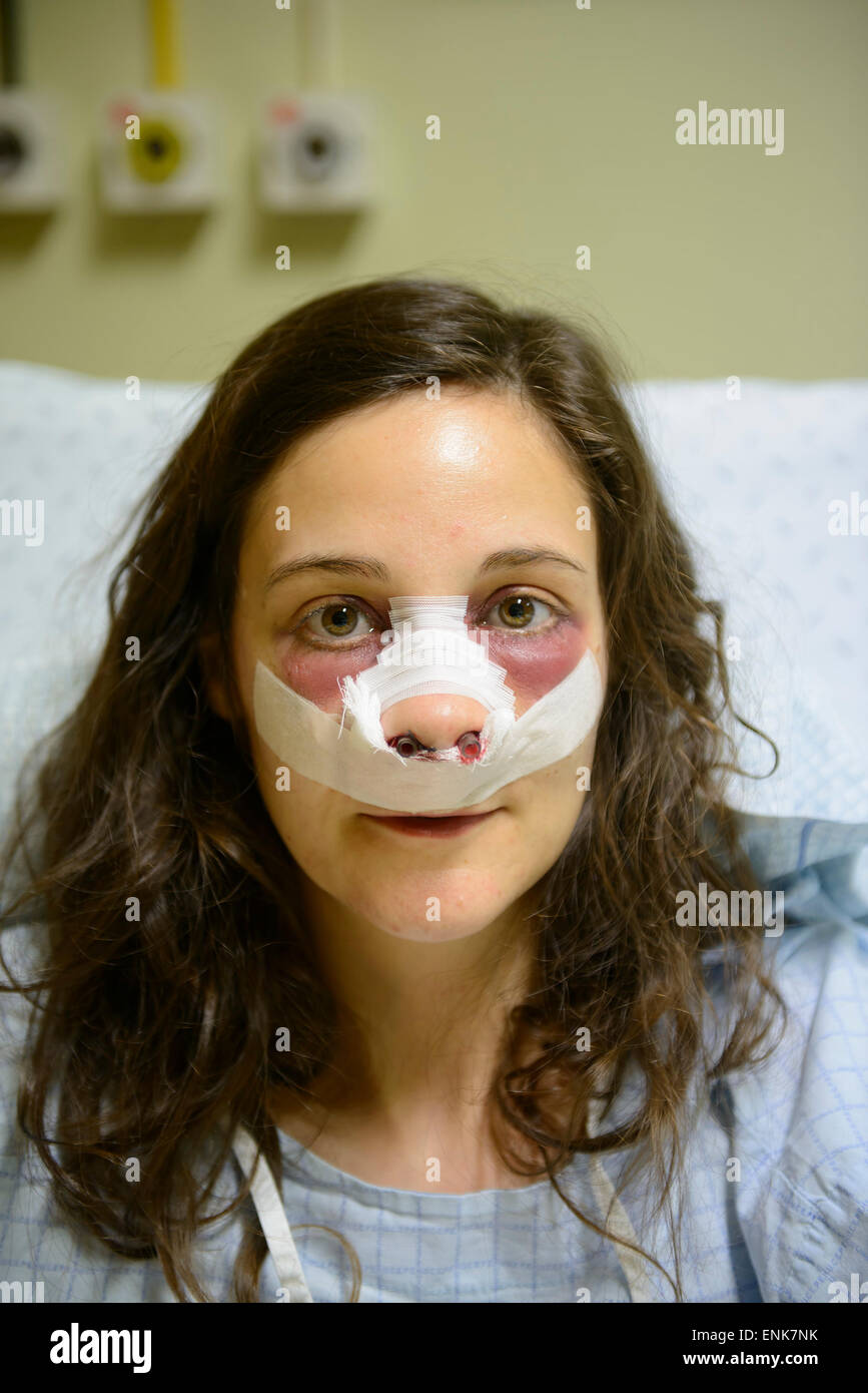 Young woman with bandages on face while recovering from a nose job (rhinoplasty) on a hospital bed Stock Photo