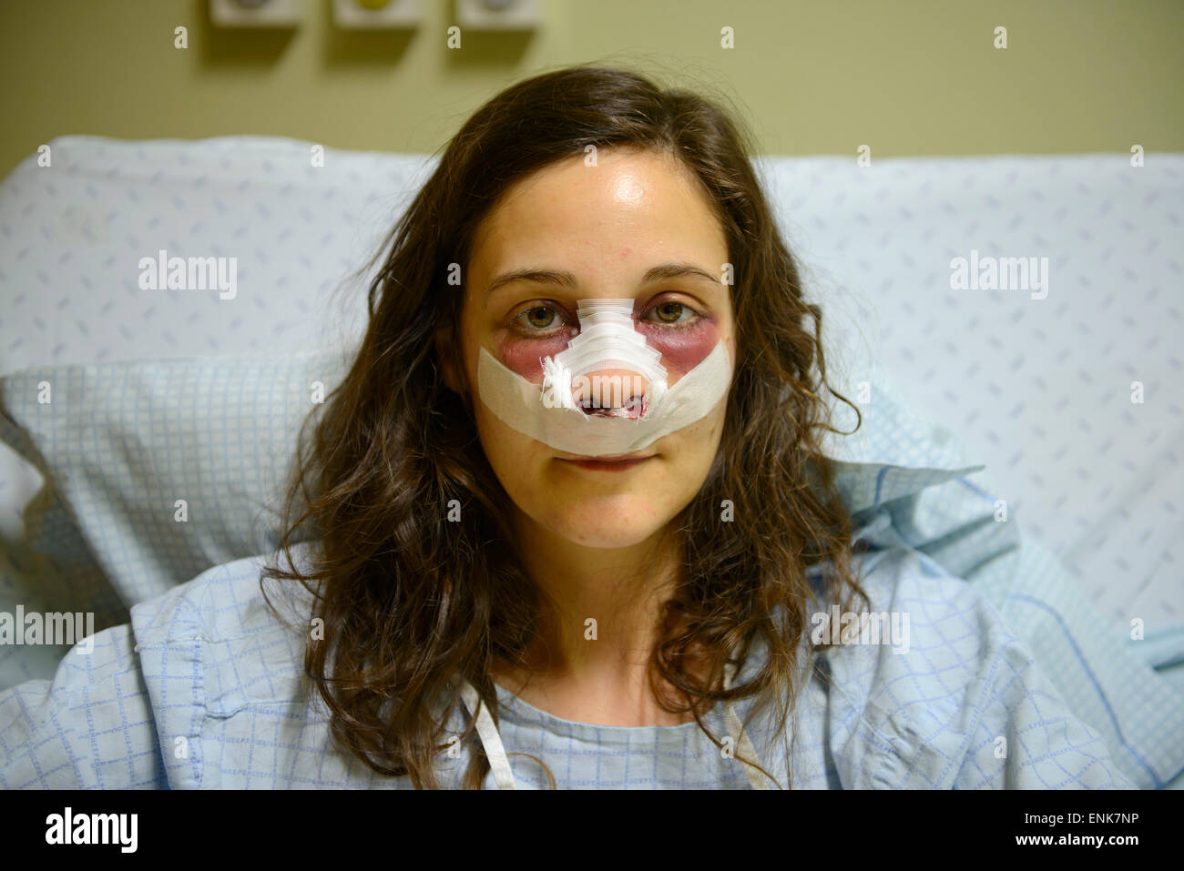 Young woman with bandages on face while recovering from a nose job (rhinoplasty) on a hospital bed Stock Photo